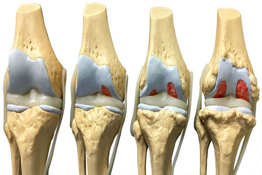 etapas del desarrollo de la osteoartritis