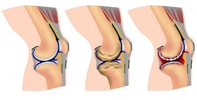 Fase de desarrollo de la artrosis de la articulación de la rodilla