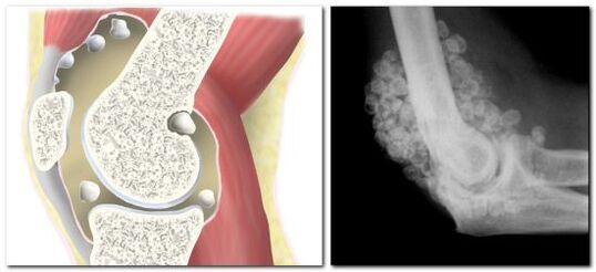 Condromatosis con dolor en la articulación de la cadera.